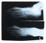 X-Ray photo of feet
